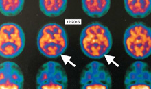 HBOT zeigte Verbesserung der Alzheimer-Krankheit
